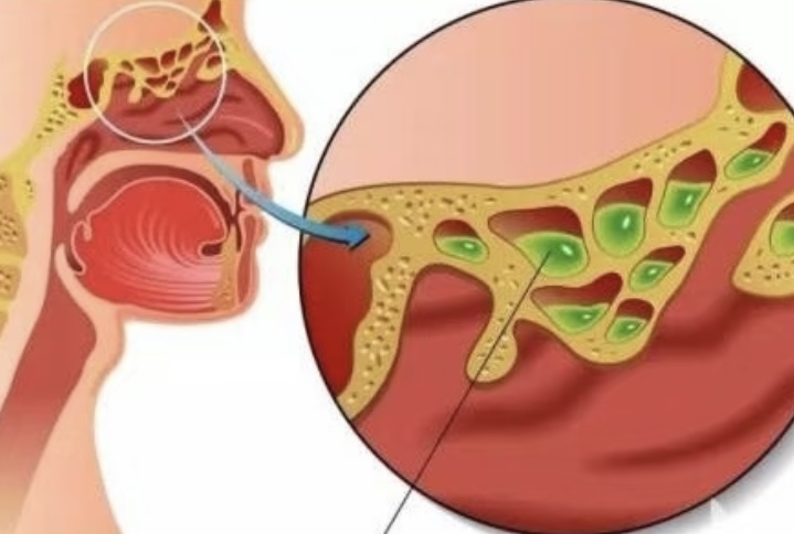 Efficacy and Safety of CT-guided Ozone Neurolysis of the Gasserian Ganglion for Idiopathic Trigeminal Neuralgia in Elderly Patients (≥70 Years Old) – A Retrospective Observational Cohort Study